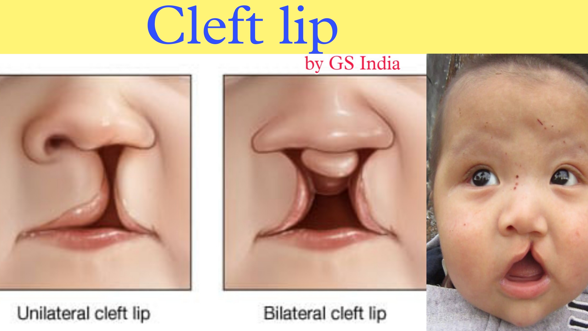 cleft-lip-and-cleft-palate-gs-india-nursing-academy