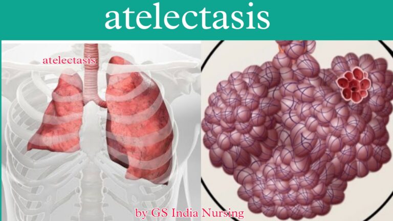 Atelectasis, Definition Of Atelectasis, Causes, And Symptoms,and ...