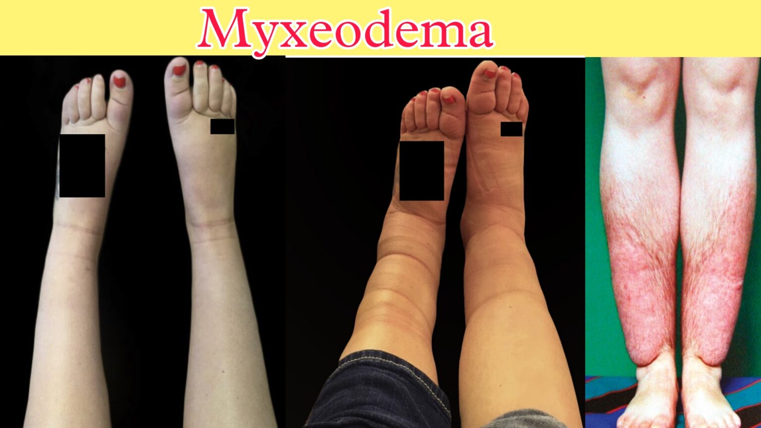 Myxedema What Is Myxeodema Sign And Symptoms Diagnosis — Gs India Nursing Academy