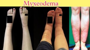 Myxedema: What is Myxeodema? Sign & symptoms, diagnosis: — GS India ...