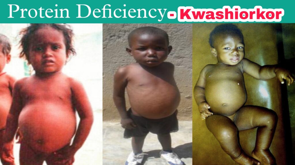 case study of kwashiorkor