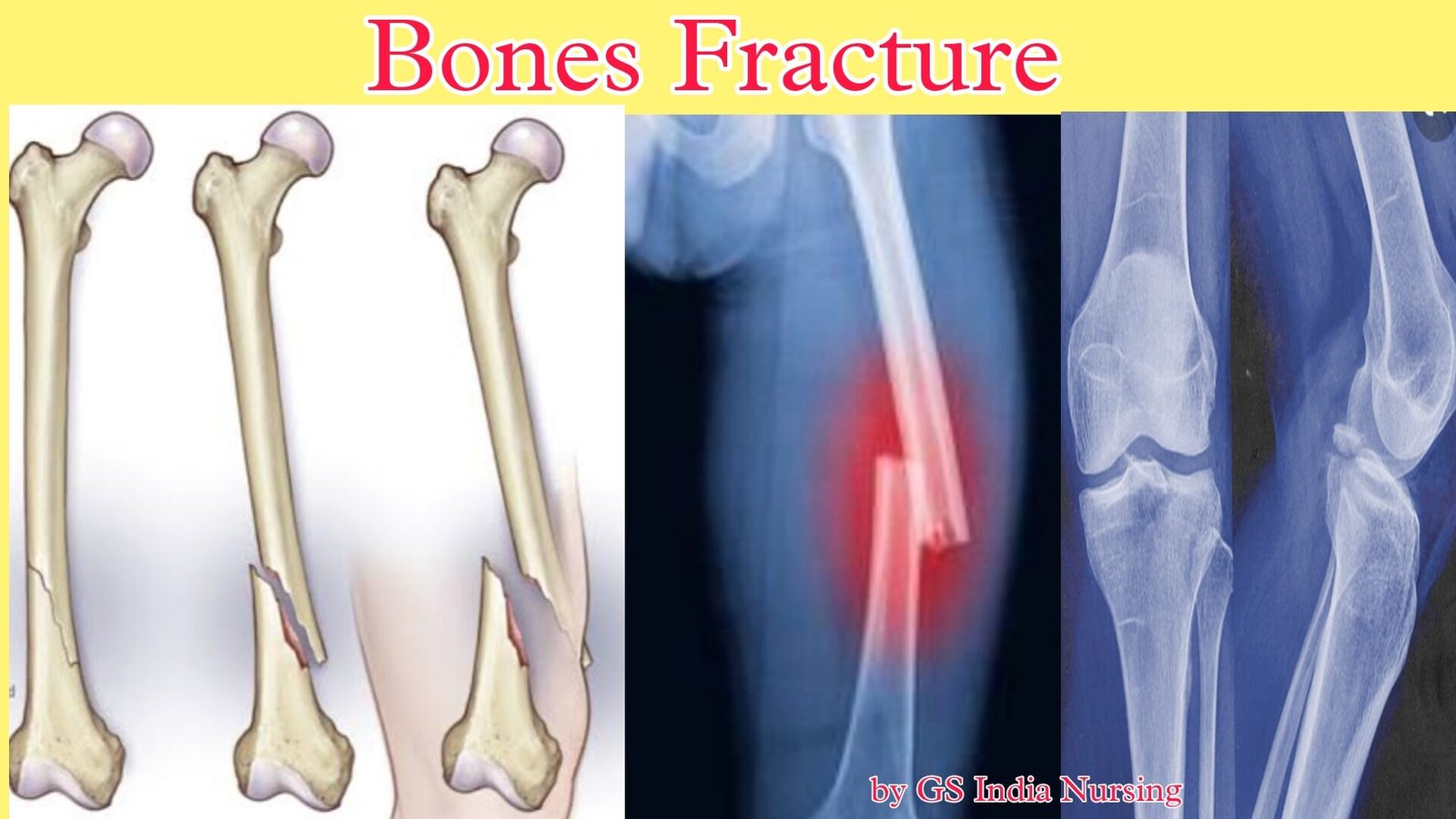 Fracture/bones fracture, types of fracture, their management — GS India