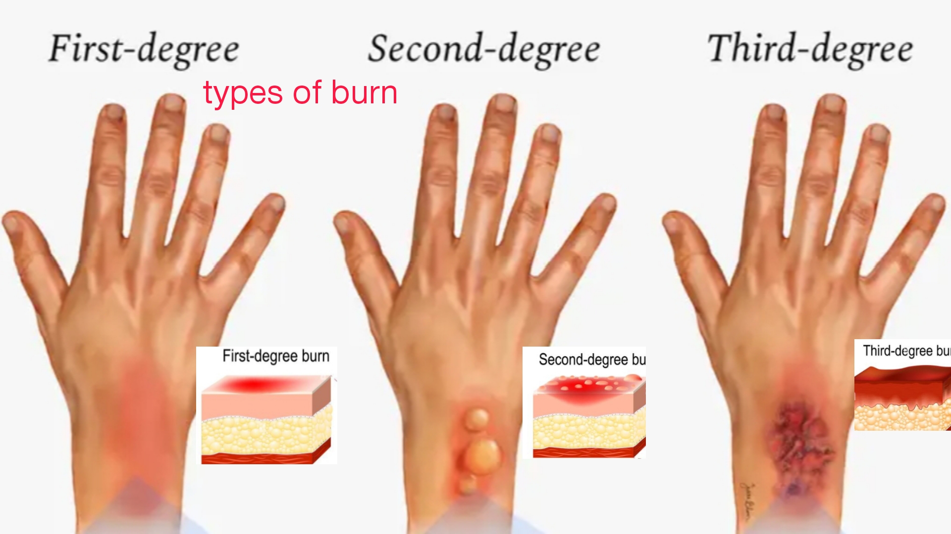 Burn, (Rule of nine(9) Causes of Burn, & Classification of Burn, Burn ...